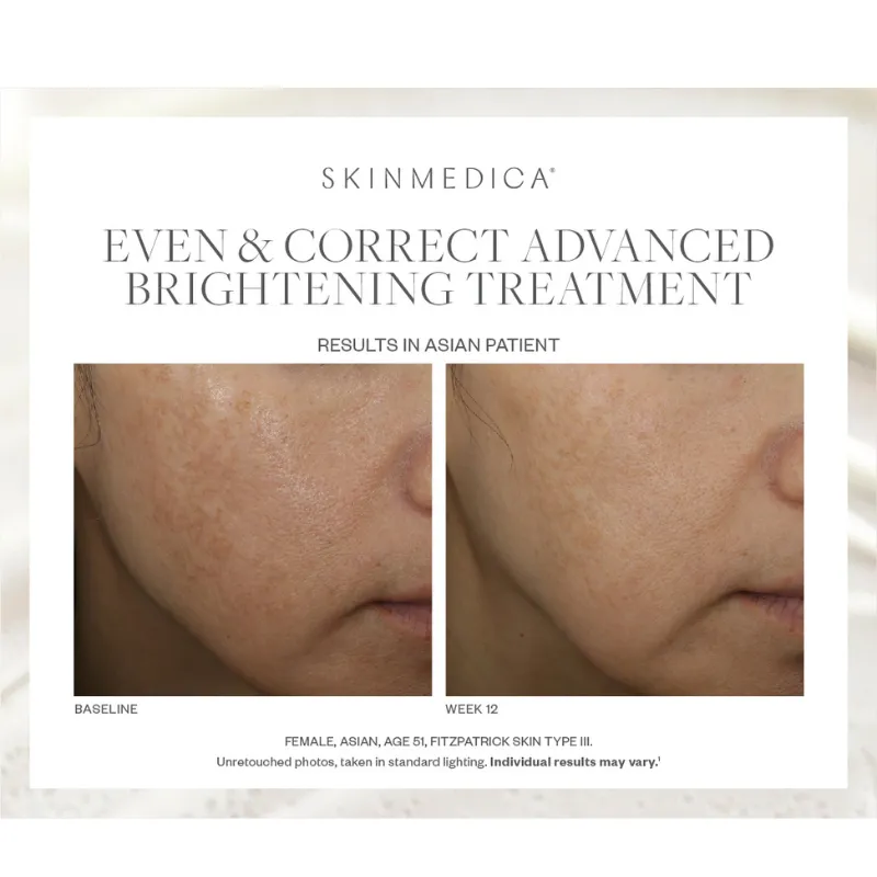 SkinMedica Even & Correct Advanced Brightening Treatment