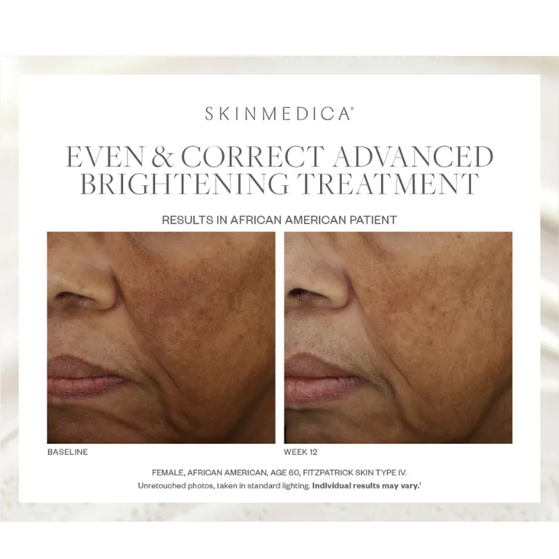 SkinMedica Even & Correct Advanced Brightening Treatment